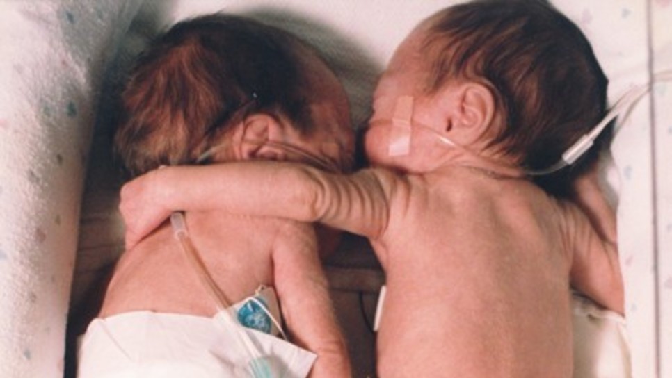 Τα πρόωρα δίδυμα που αγκαλιάστηκαν στη θερμοκοιτίδα σώζοντας το ένα τη ζωή του άλλου